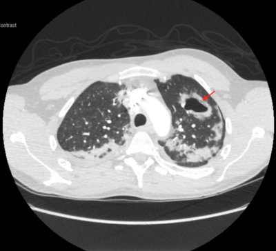 covid19, coronavirus, lungs, getty covid19, coronavirus, lungs, getty