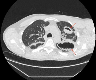 covid19, coronavirus, bmj case reports covid19, coronavirus, bmj case reports