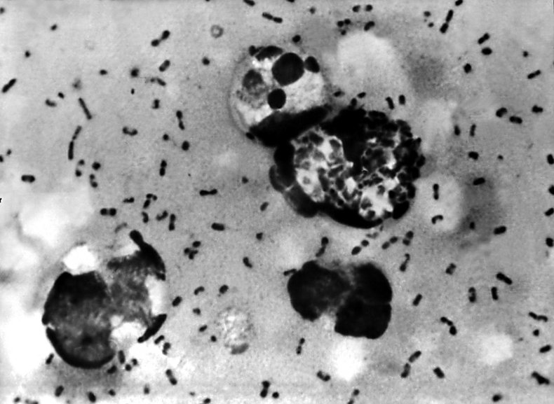 Yersinia pestis, Bubonic plague smear