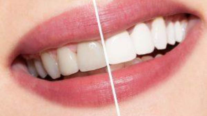 Newsweek Amplify - Teeth Whitening