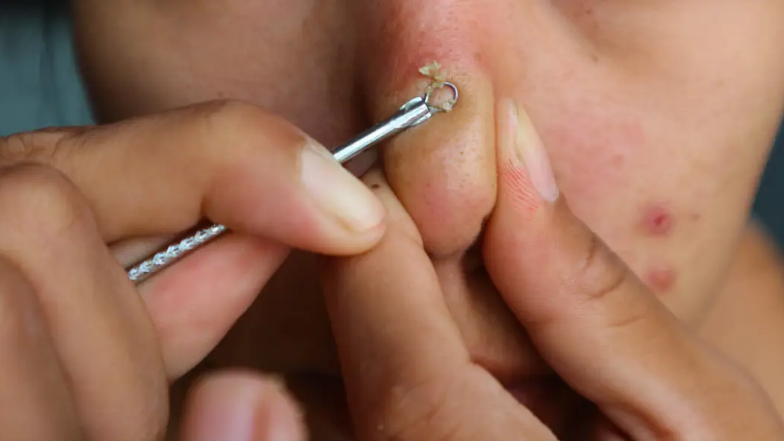 Teen Gets Brain Infection After Popping a Pimple on This Part of