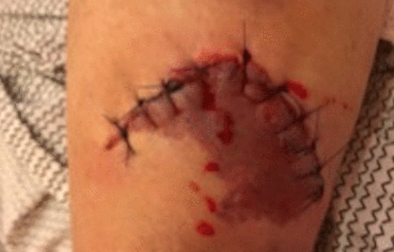 BMJ case reports, Necrotizing Soft Tissue Infection,NSTI