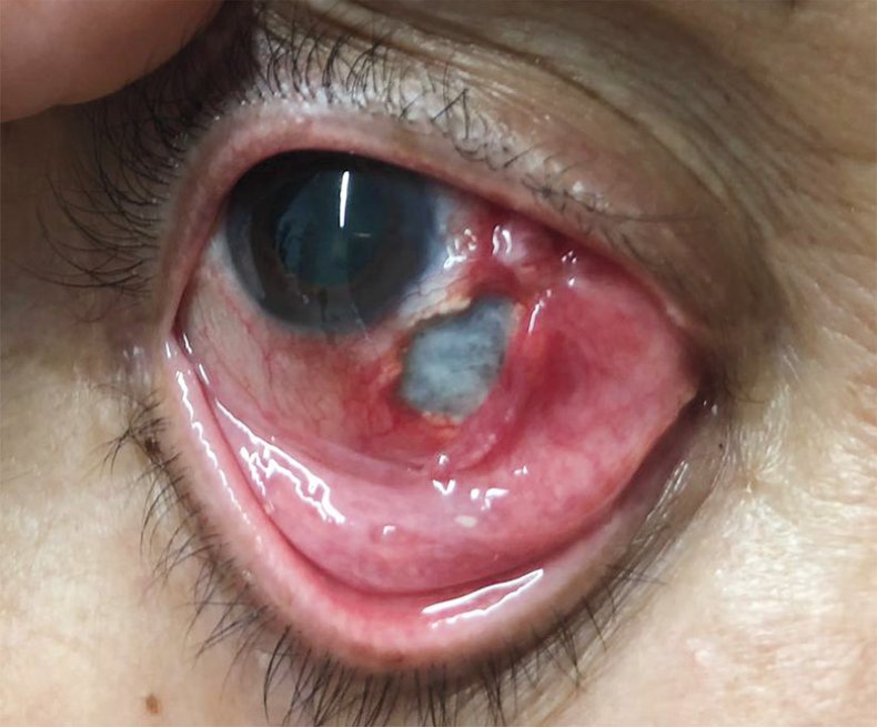 necrotizing scleritis