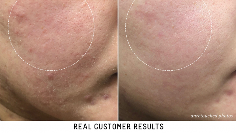 Before and After using Biossance Before and After using Biossance