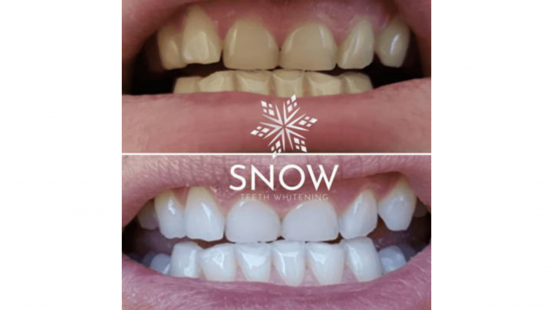 The Teeth Whitening Kit Used By Celebrities