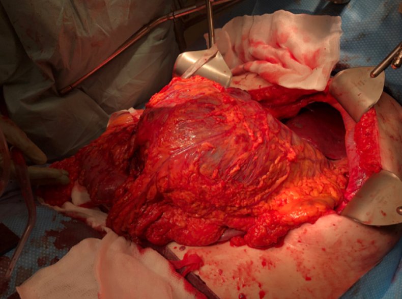 BMJ case reports, tumor,