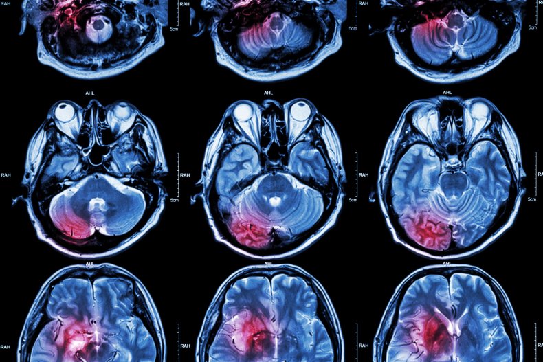 MRI scan