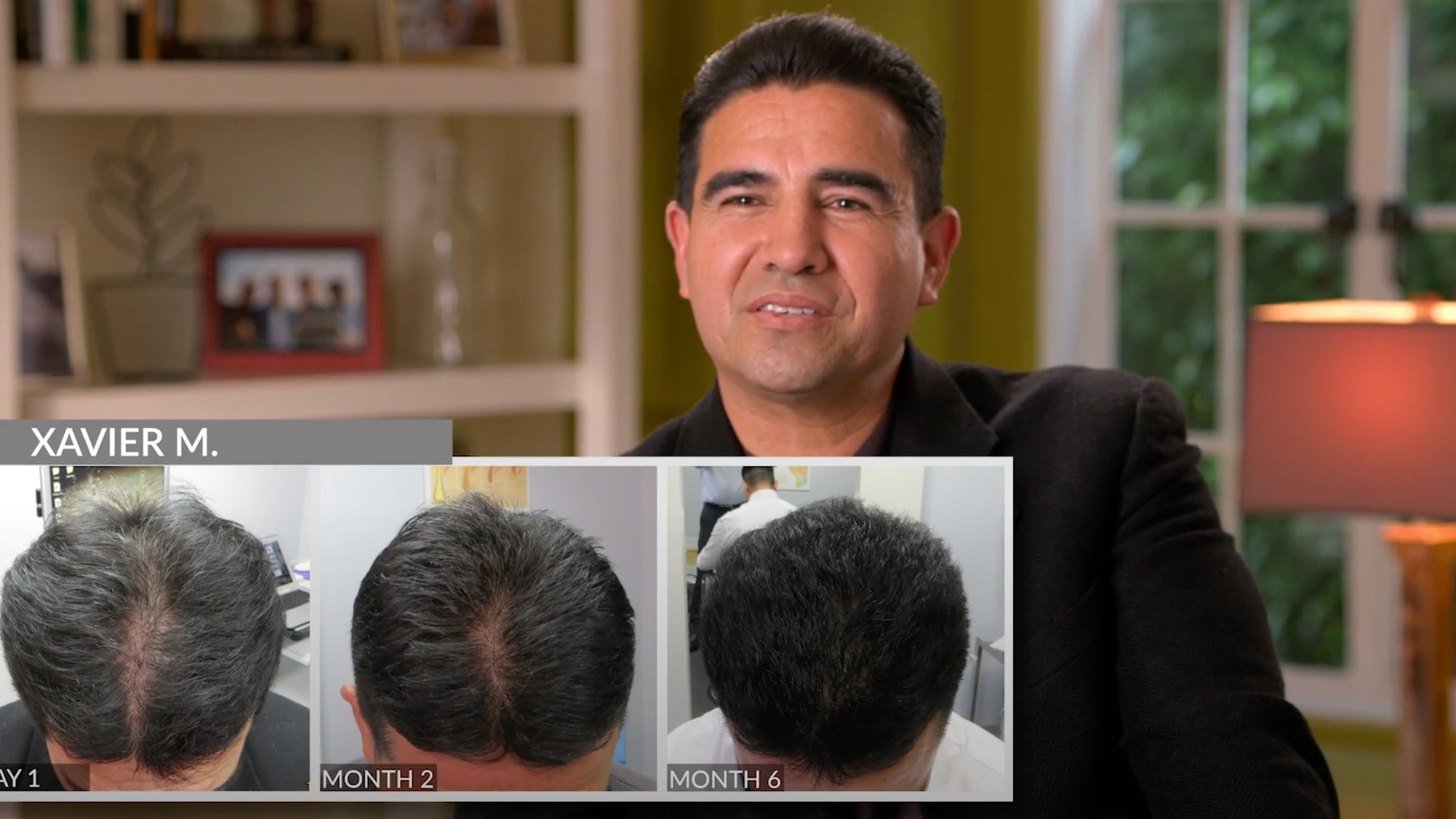 How You Can Stop Hair Loss and Regrow What You Lost Without Surgery