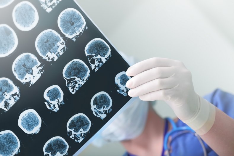 brain hemorrhage, stroke, brain
