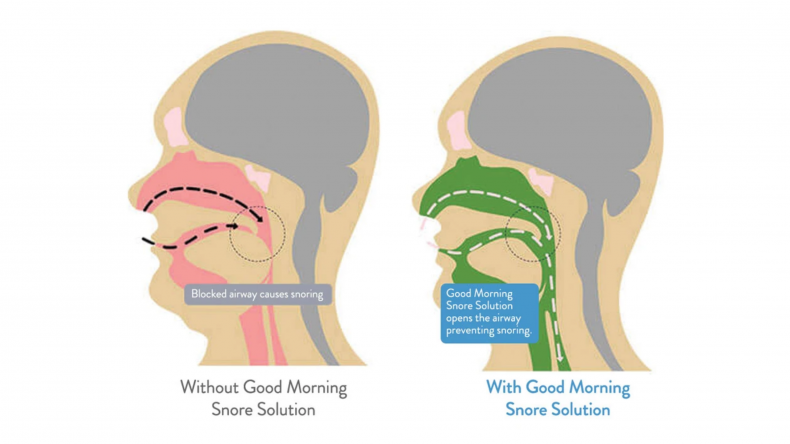 Tongue Stabilization