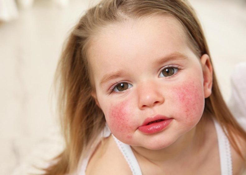 Food allergy symptoms appear within two hours