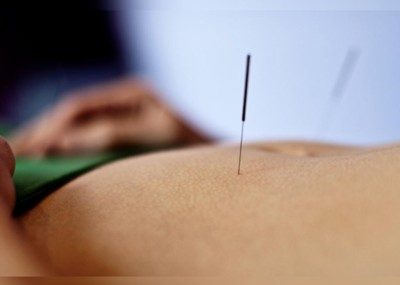 1971: Acupuncture