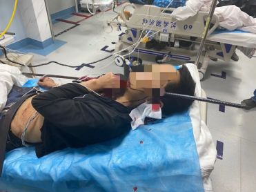 Chinese Builders Head Impaled By Steel Bar Chinese Builders Head Impaled By Steel Bar