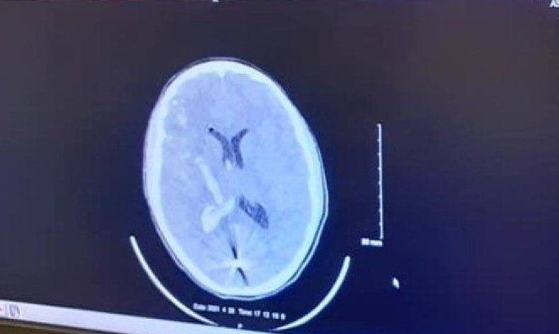 Scan of BB in Deven Free's brain