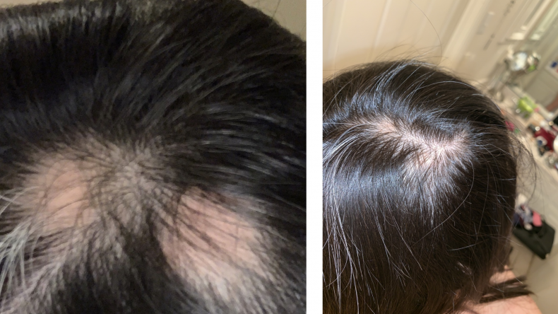 10 Before and After Photos of Satisfied Users of SugarBear Hair Gummies