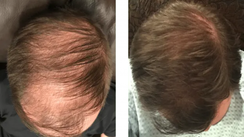skøn afvisning fred Before and After Photos of Men Who Managed Their Hair Loss—and How They Did  It