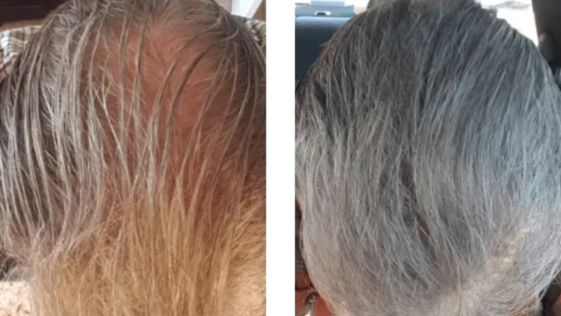 Slime Skære maskine Before and After Photos of Men Who Managed Their Hair Loss—and How They Did  It