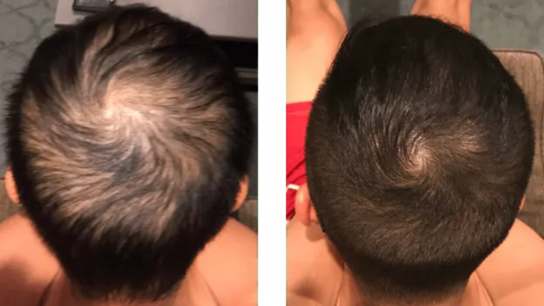 Before and After Photos of Men Who Managed Their Hair Loss—and How They Did It Before and After Photos of Men Who Managed Their Hair Loss—and How They Did It