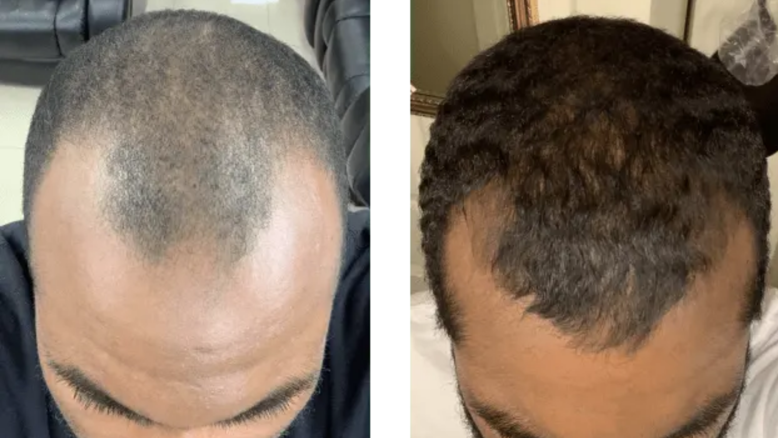 Aggregate more than 132 finasteride before hair transplant best