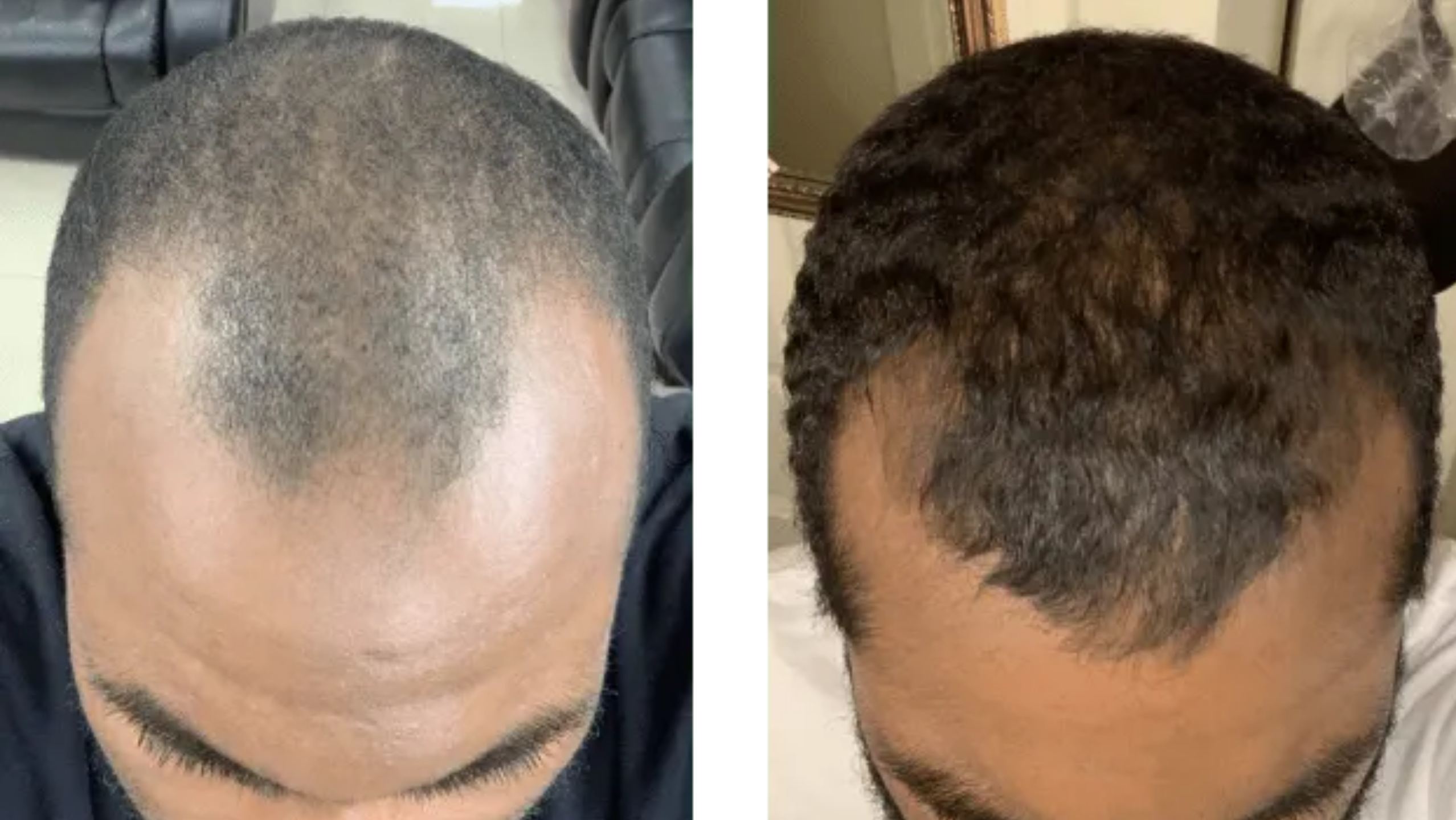 Why Am I Losing More Hair After Just Starting Hair Loss Treatment