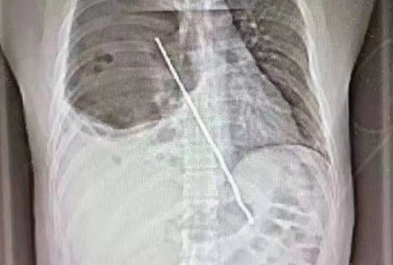 Man Swallows Barbecue Skewer While Drunk