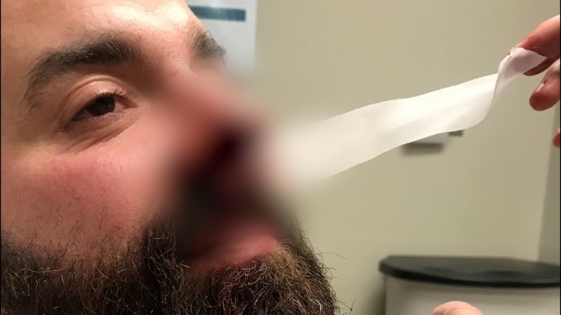 Louisiana man had nose partially bitten off.