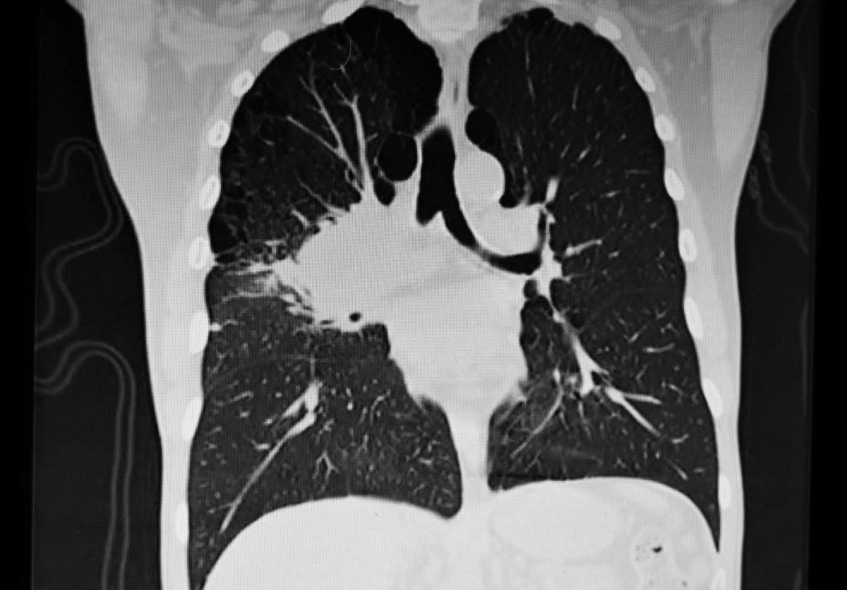 Image of a right hilum lung tumor