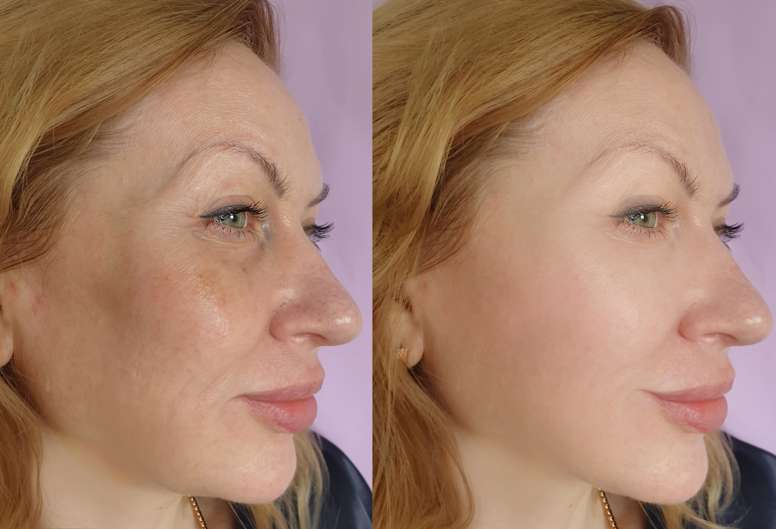 Woman Takes Photo Every Day Revealing How Long It Takes for Botox to Work