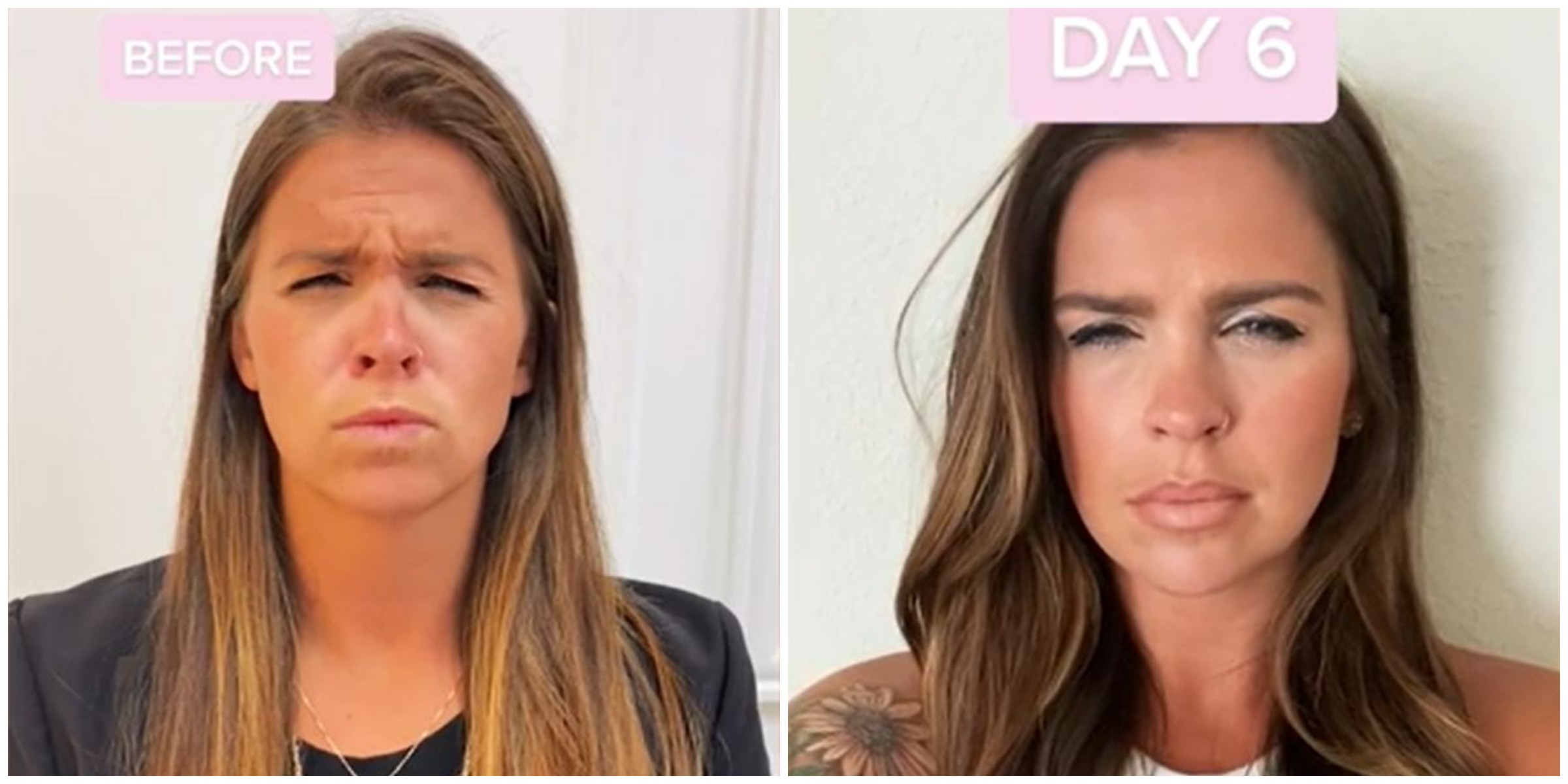 Woman Takes Photo Every Day Revealing How Long It Takes For Botox To Work