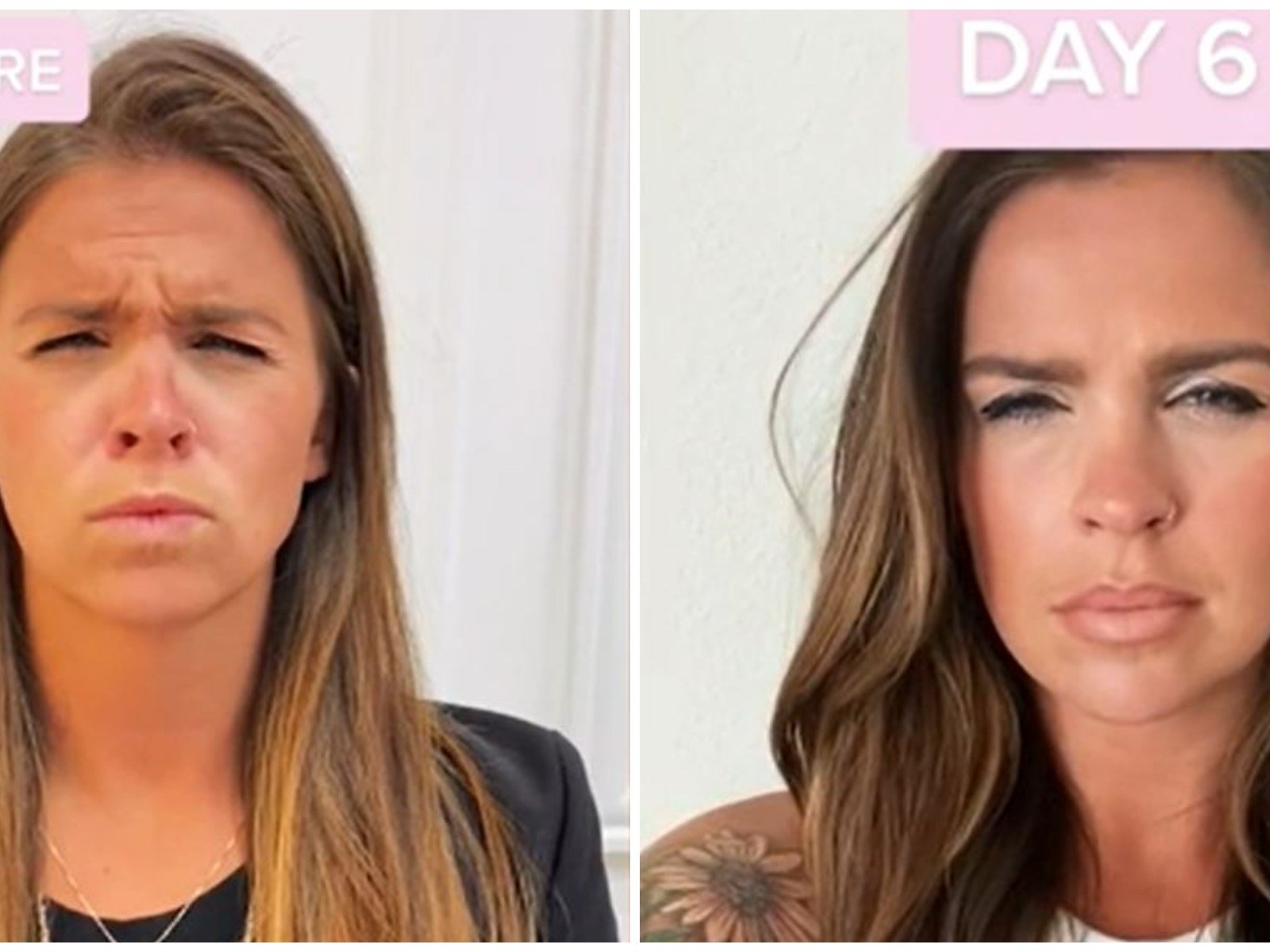 Woman Takes Photo Every Day Revealing How Long It Takes for Botox