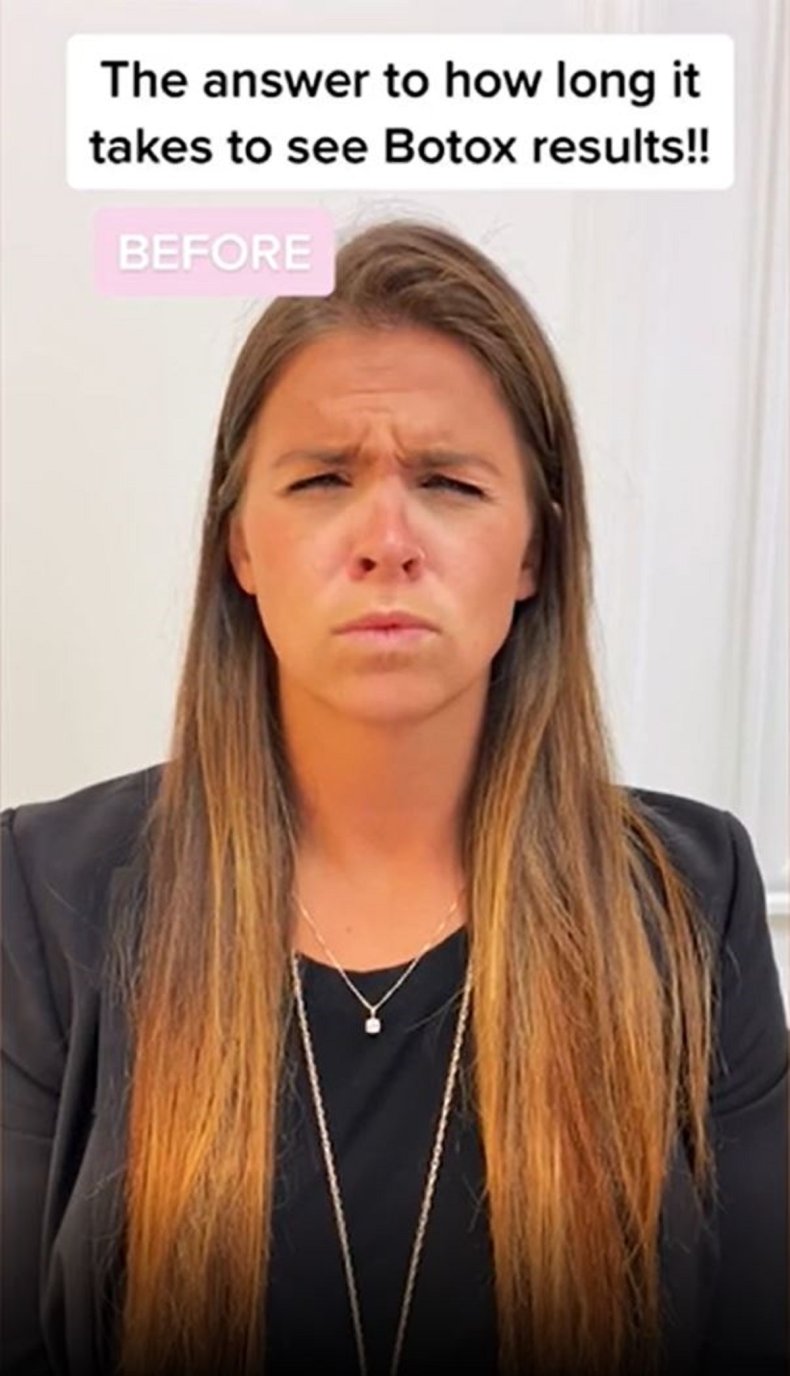 The before shot of woman getting botox