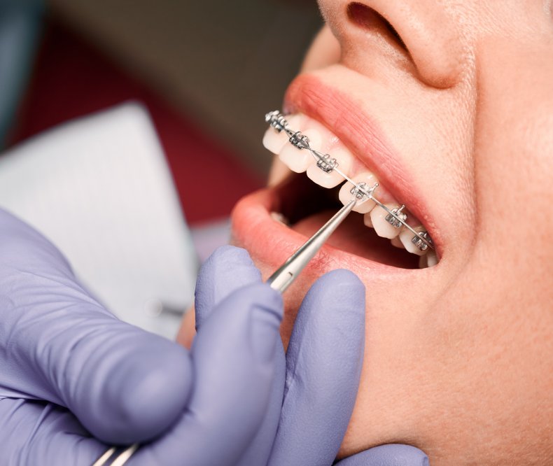 Orthdontist working with braces 