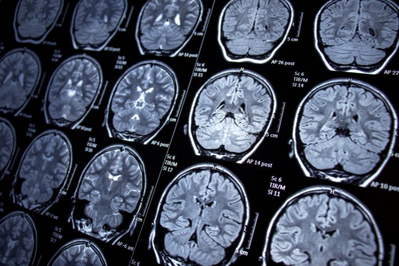 Aidan Fruit Shows Promise For Epilepsy Treatment