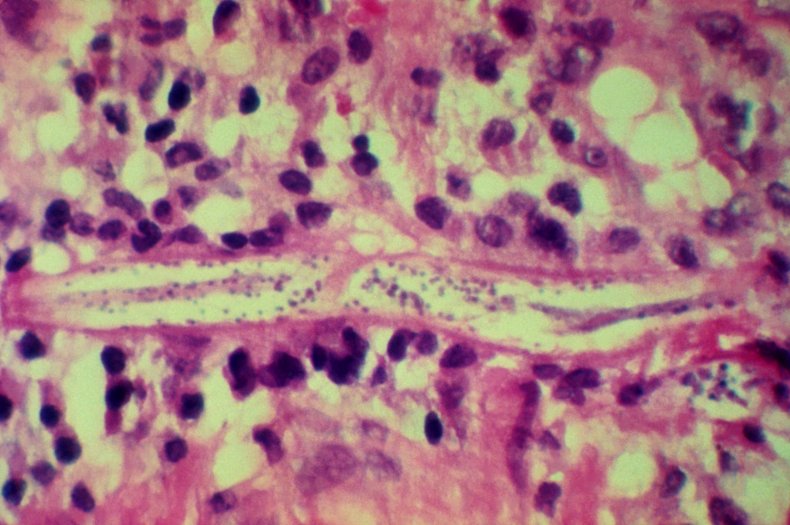 A micrograph of a strongyloides stercoralis parasite.