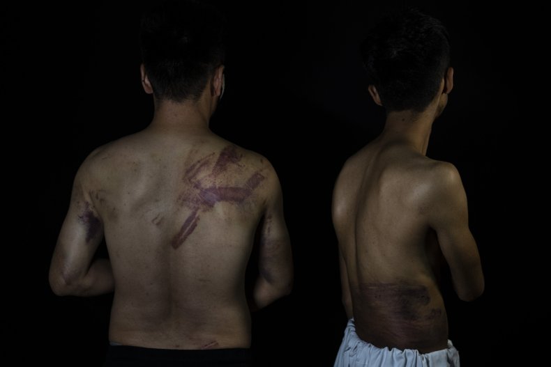 Journalists show bruises from Taliban