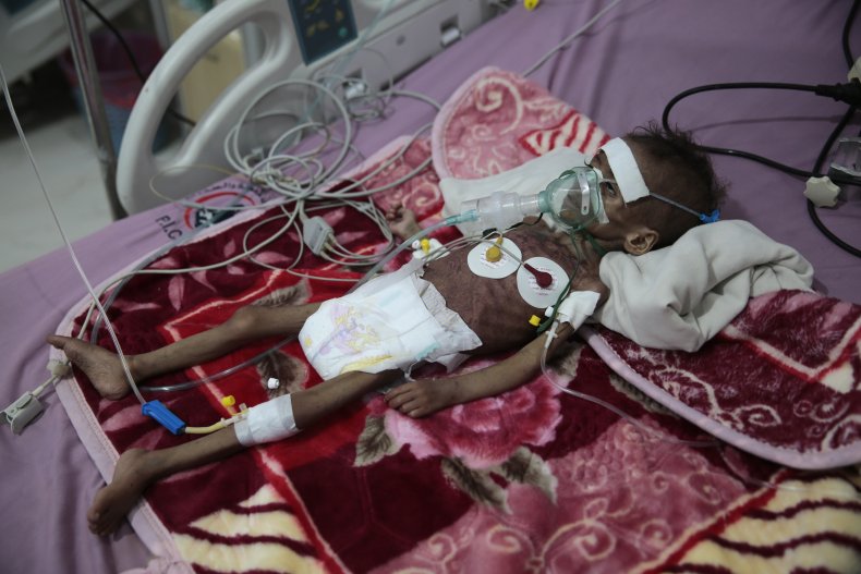 Yemen Children Starvation