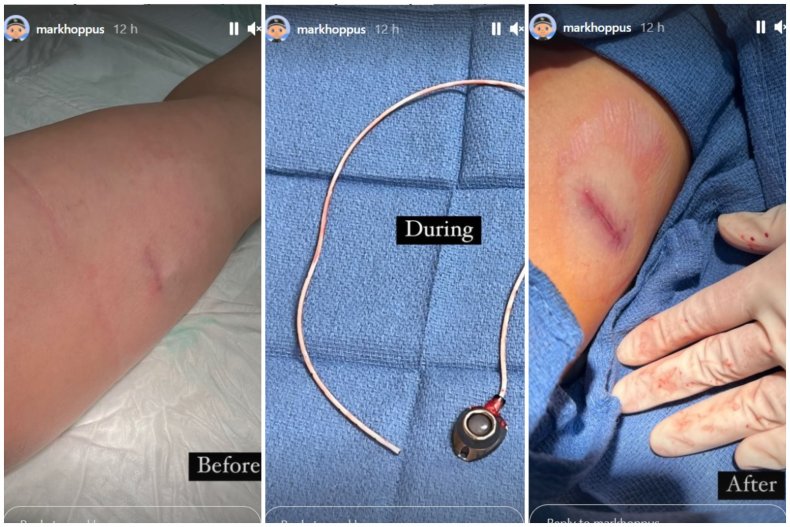 Mark Hoppus Shares Surgery Photos