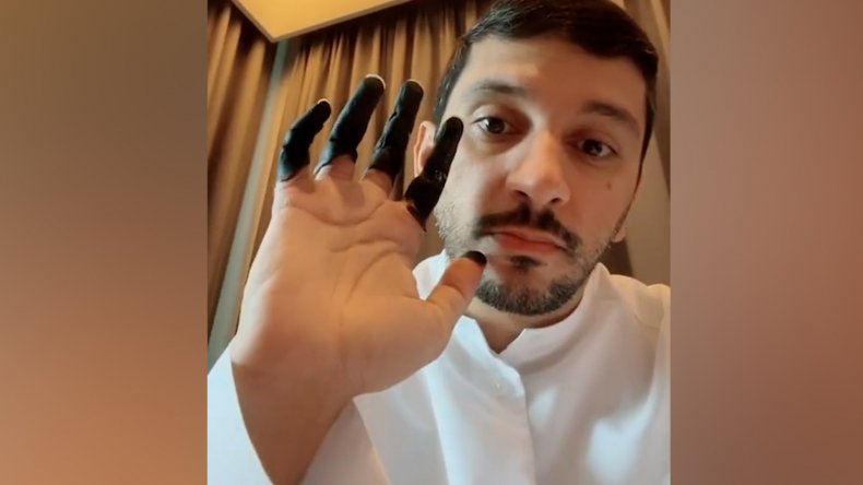 Fahad Badar shows his frostbitten fingers.