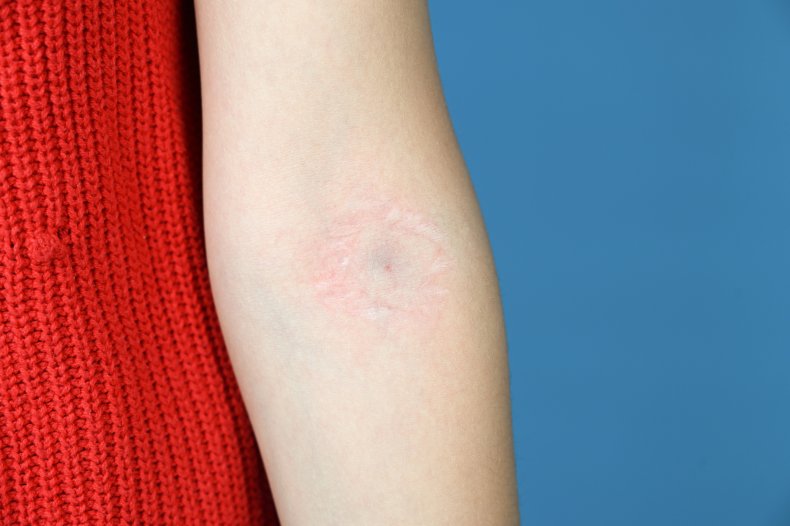 TikToker Thinks She Was Possibly Injection Spiked
