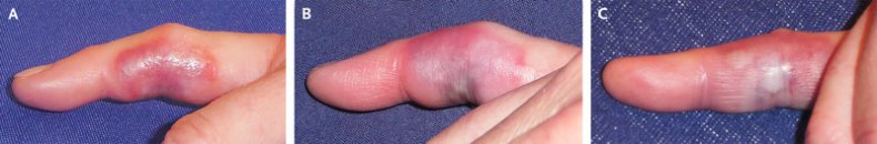 yellow sac spider bite
