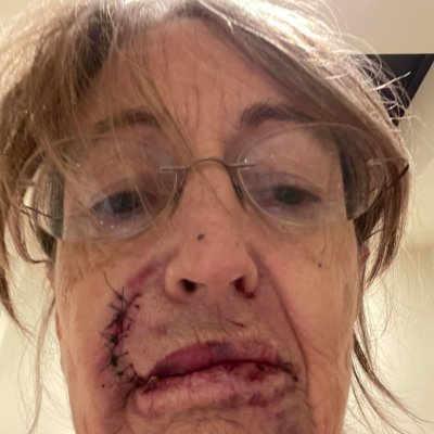 Laurel-Roses Bear Attack Injuries Laurel-Roses Bear Attack Injuries
