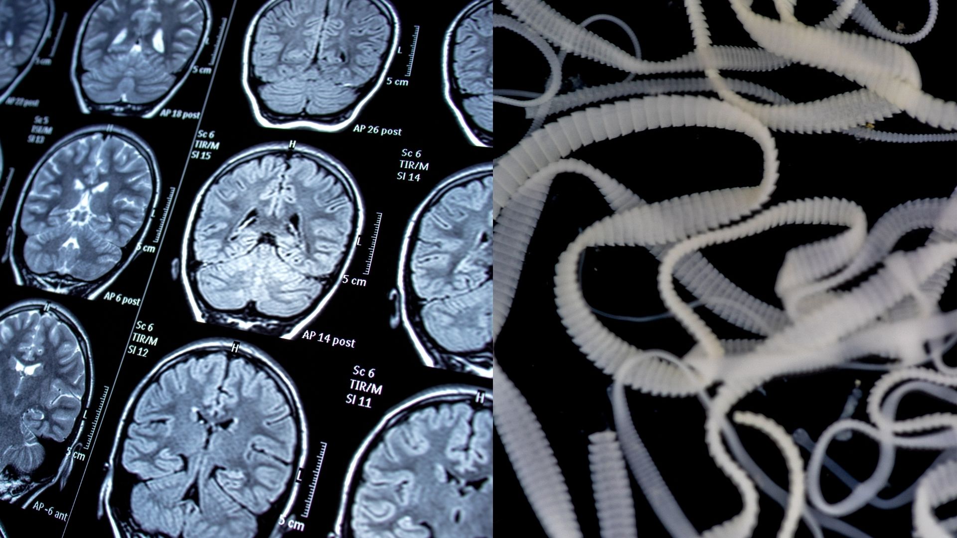 Symptoms Of Tapeworm In The Brain Explained As Man Diagnosed After 