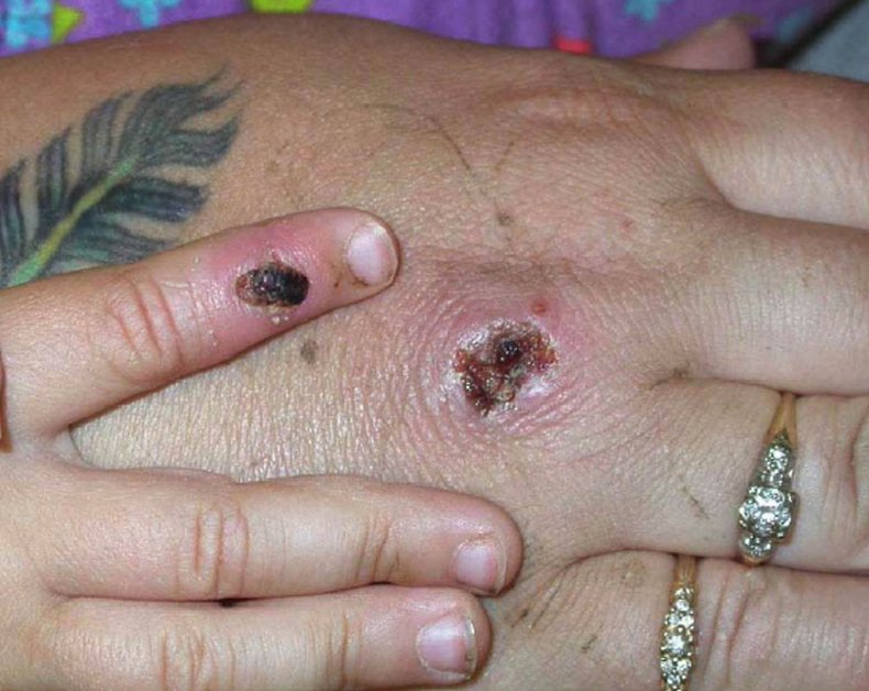 Monkeypox lesion