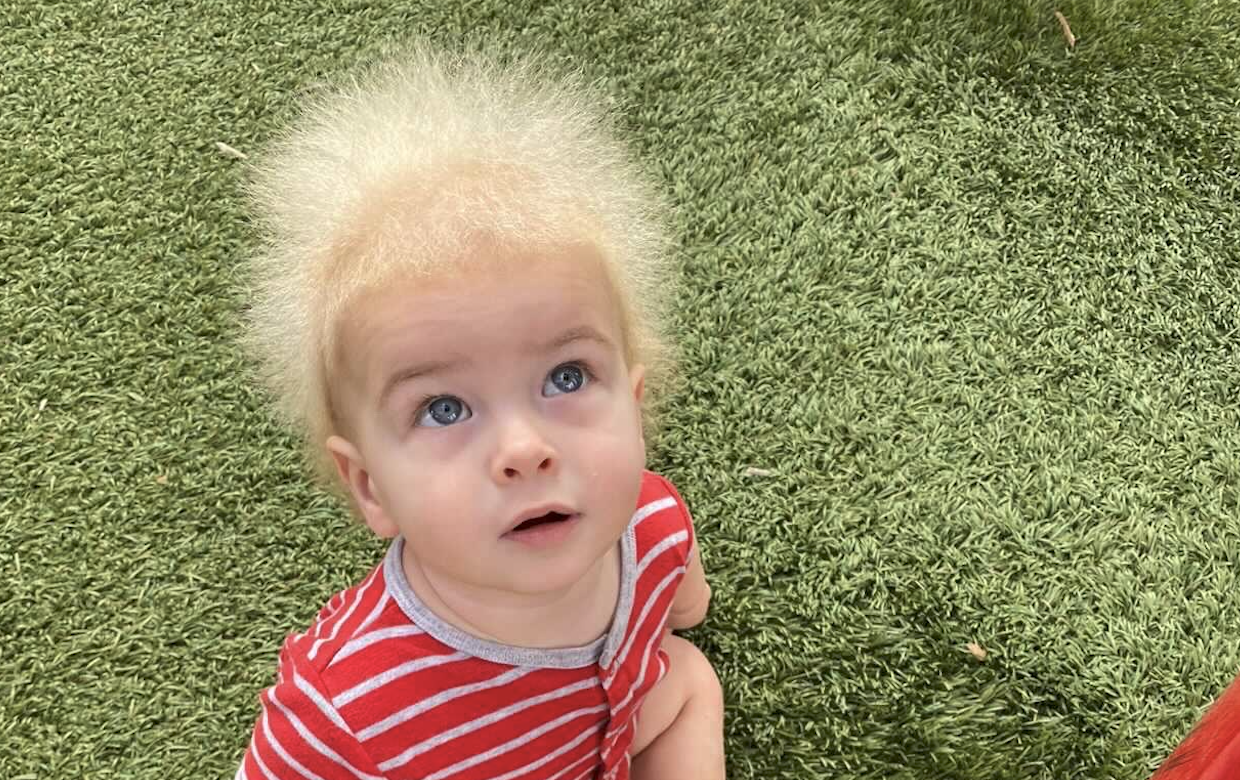 Toddler Is One Of 100 In The World To Have Uncombable Hair Syndrome