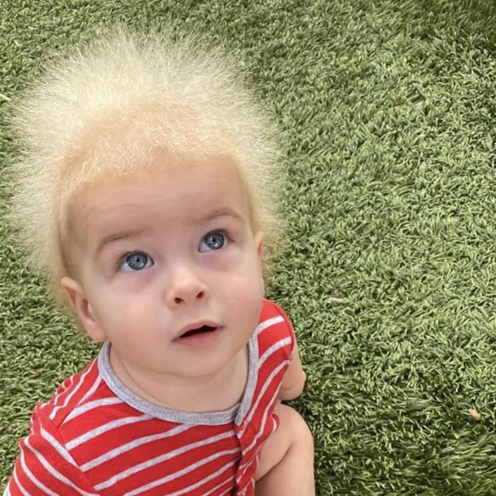 100 Confirmed Cases in the World': Boy Diagnosed With Rare Uncombable Hair  Syndrome