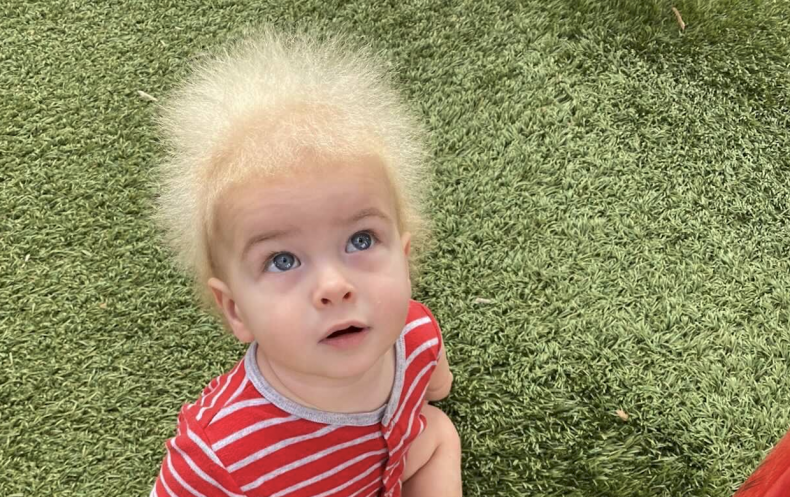 Young Boy Suffers from Rare Hair Condition