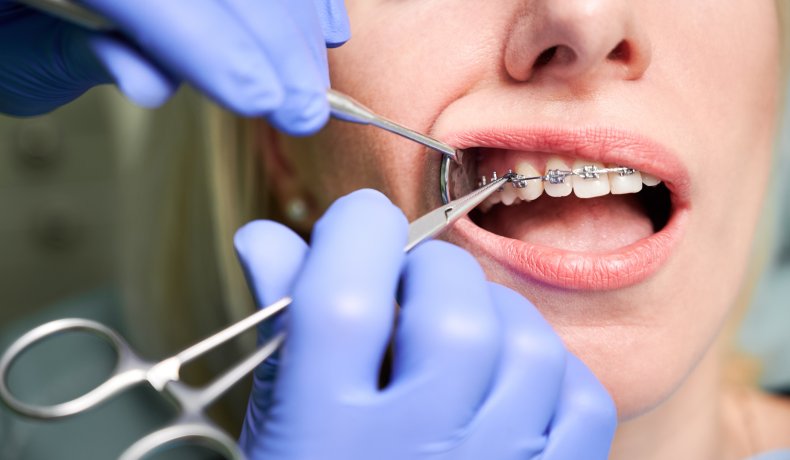 Braces