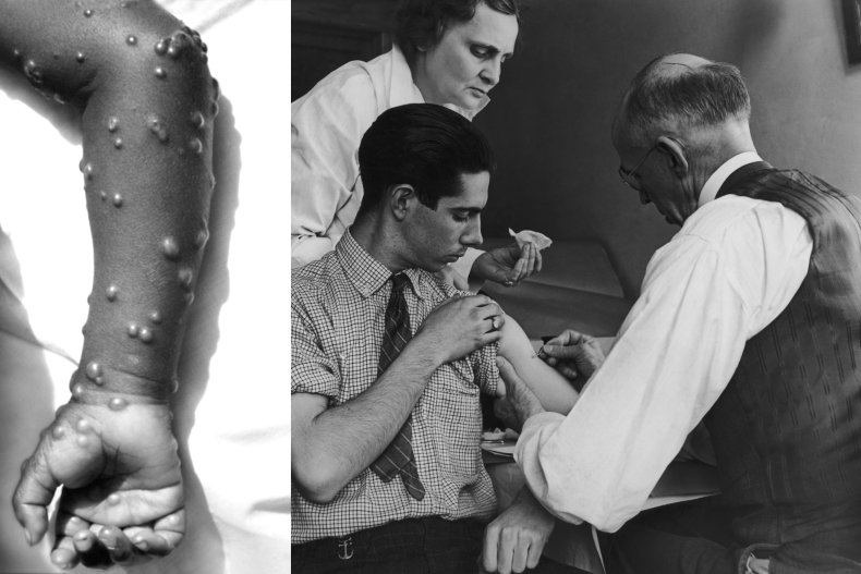 Smallpox vaccination comp image