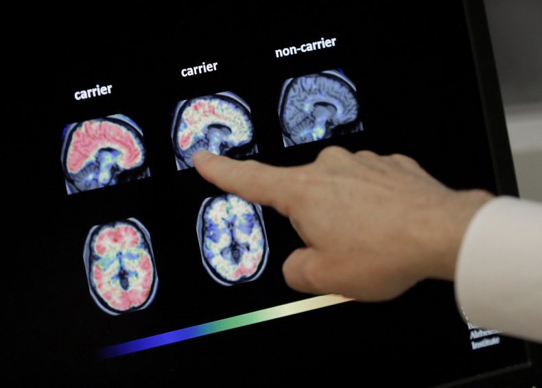 Pet Scan, Alzheimer’s Disease