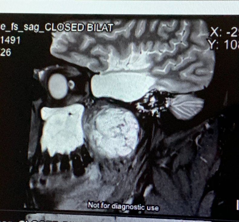 A Scan of David Fittings Osteosarcoma Tumor
